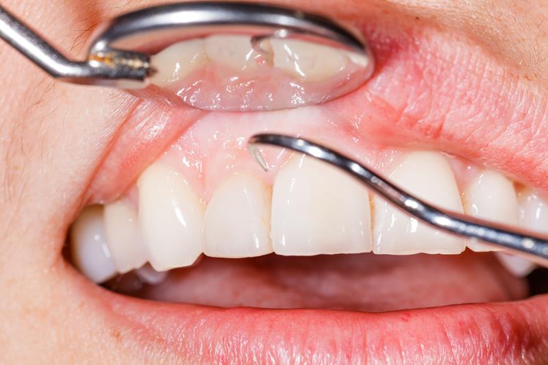 Gum Disease Woodland Hills, CA 